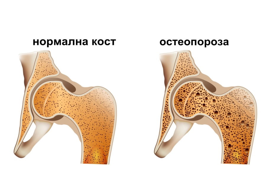 РЗИ-Пазарджик напомня: 20 октомври – Световен ден без остеопороза