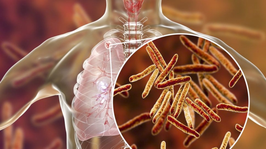 Всички нови болни от туберкулоза тази година са с преболедуван Ковид