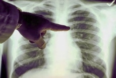 ​Заболеваемостта от туберкулоза остава над средната за страната