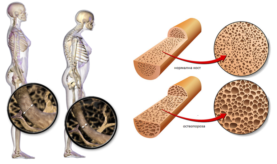 В Пазарджик: Скринингова кампания за определяне на риска от остеопороза